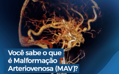 Você sabe o que é Malformação Arteriovenosa Cerebral?